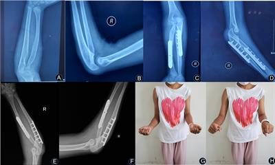 Derotational Osteotomy and Plate Fixation of the Radius and Ulna for the Treatment of Congenital Proximal Radioulnar Synostosis
